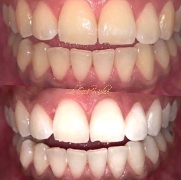 izbijeljivanje08
